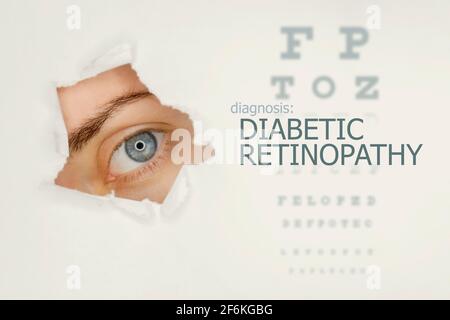 Frau`s Auge schaut durch ein zerrtes Loch in Papier, Augentest mit den Worten Diabetische Retinopathie auf der rechten Seite. Vorlage für das Konzept der Augenerkrankung. Grauer Hintergrund. Stockfoto